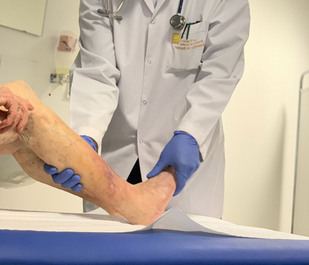 LYMPHODÈME / LIPOEDÈME