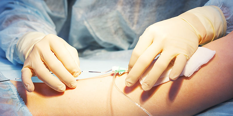 Endoveineuse (laser)